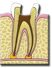 endo-2