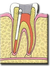 endo-5