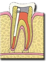 endo-6