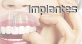 implantes dentales